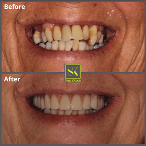 Before and after dental implant result 1