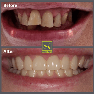 Before and after dental implant result 2