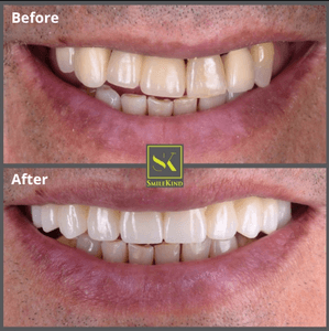 Before and after dental implant result 3